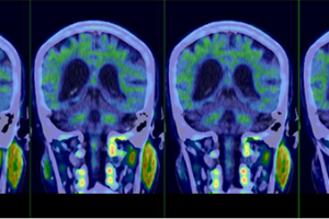 Development of Clinical Techniques and Basic Research Leads to Two Breakthroughs in Alzheimer’s Disease Treatment